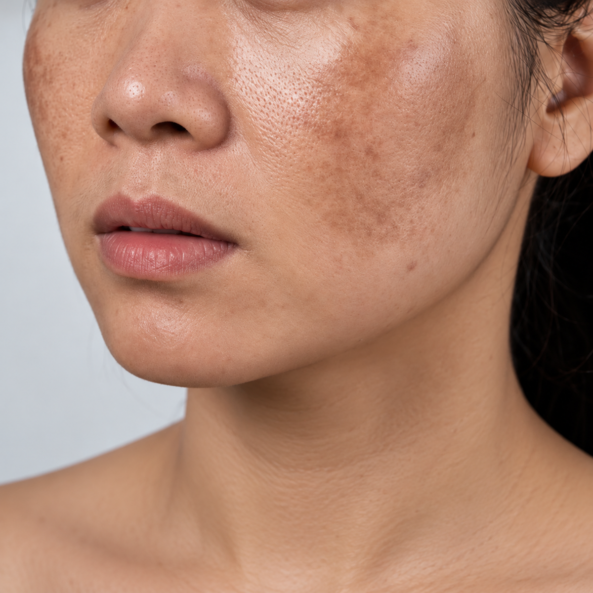 Sérum Facial Ácido Tranexâmico Anti-Manchas